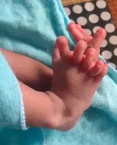 India Baby with 26 fingers and toes